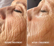 Load image into Gallery viewer, LIFTY PLUS GLYCOLIFTING HIGH TENSION KIT