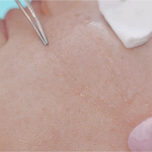 Load image into Gallery viewer, LIFTY PLUS GLYCOLIFTING HIGH TENSION KIT