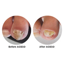 Load image into Gallery viewer, Famous Names Aceso, Before and After. Powered By Natural Bio-Actives.
