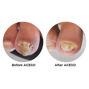 Famous Names Aceso, Before and After. Powered By Natural Bio-Actives.