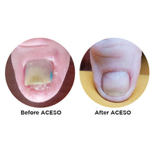 Load image into Gallery viewer, Famous Names Aceso, Before and After. Powered By Natural Bio-Actives.
